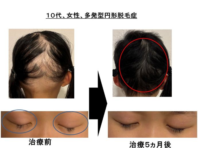 円形脱毛症　病院